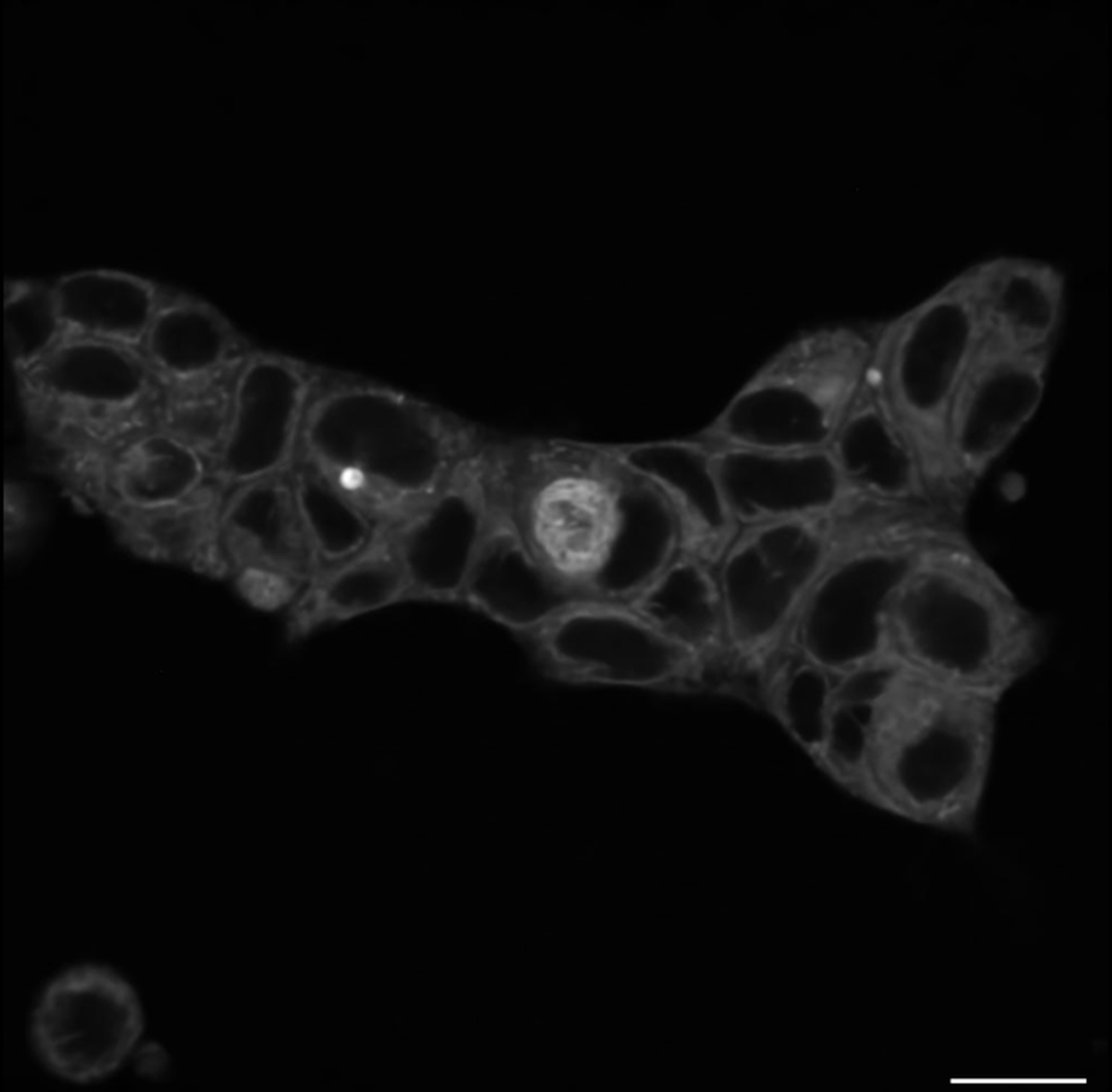 Fluorescence microscopy of a cluster of cancer cells with a single cell showing bright nuclear APOBEC3A signal